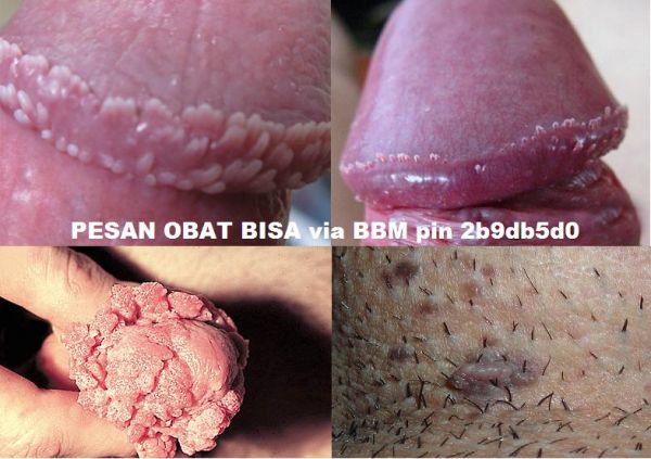 penyakit kelamin laki laki