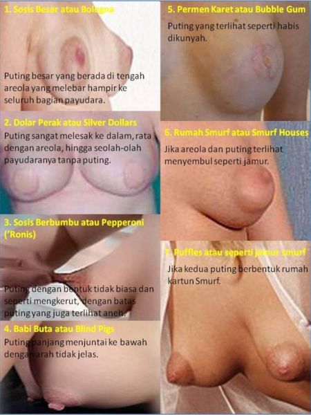 penyakit di puting susu