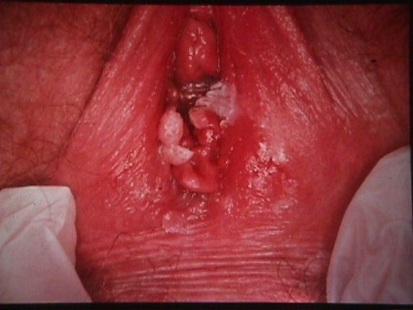 parts of the outer vagina