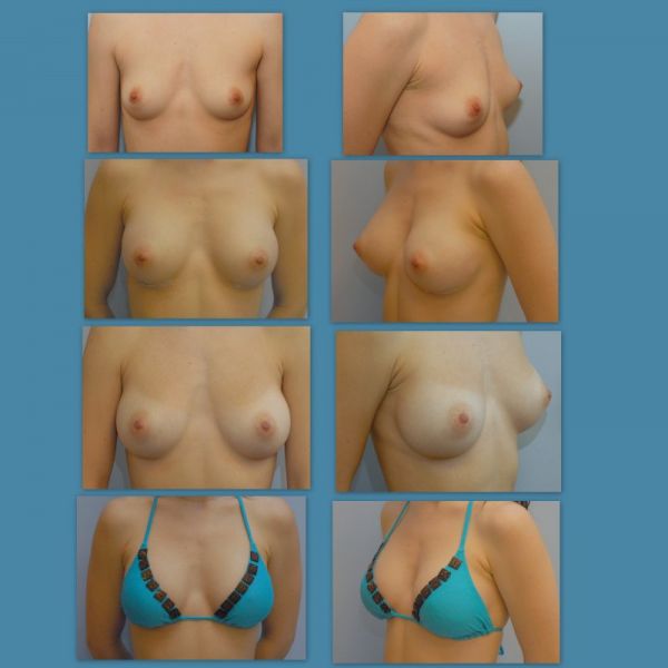lesbian boobs